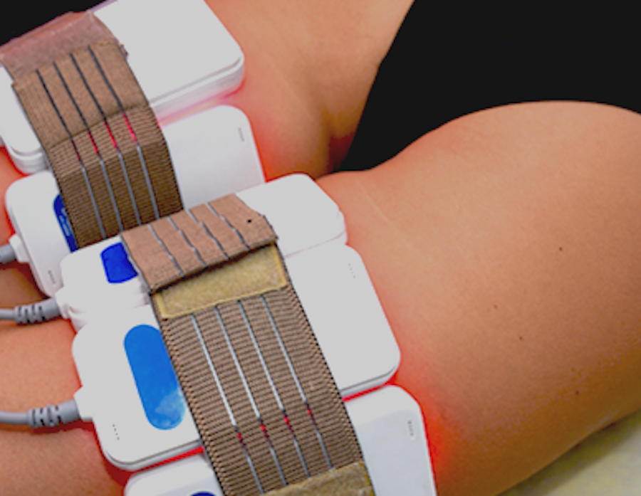 Lipo Cavitation Treatment (RF)