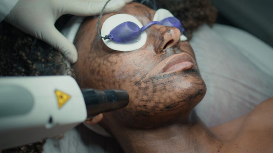 Laser Carbon Peel