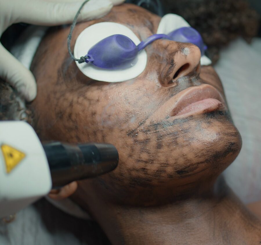 Laser Carbon Peel
