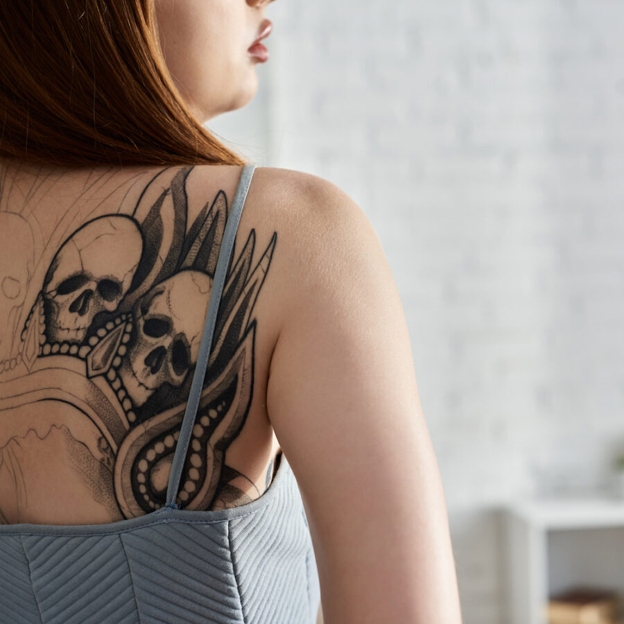 Laser Tattoo Removal