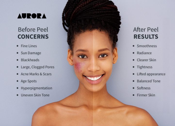 laser carbon peel